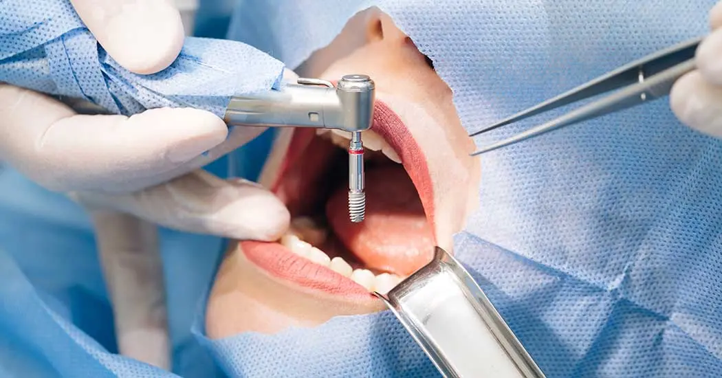 Explication de la pose d’un implant dentaire en Turquie à Istanbul